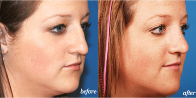 18-24 year old woman treated with Septoplasty - This patient had a history of difficulty breathing due to nasal septal deviation since birth.