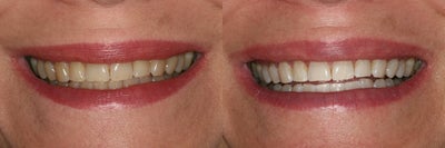 ZOOM whitening - 
	ZOOM whitening
