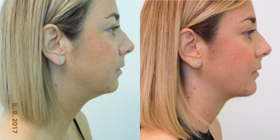 25-30 year old treated with Neck Liposuction and Chin Augmentation - This young woman presented with the desire to improve her profile. She stated that even as a younger adult (and teenager) she always had some fullness underneath her chin with lack of definition. Examination revealed a moderately sized fat pad under her chin, as well as a mildly undersized chin. She admitted that she never had considered the lack of size of her chin, and was open to the idea of a conservative chin augmentation.Under local anesthesia with mild oral sedation, we performed submental (under chin) liposuction along with placement of a medium-sized anatomic silicone chin implant. There was a small incision placed under her chin (in the natural crease) that was approximately 1/2 inch in length. Her recovery time was less than one week.Her result demonstrates a much improved neckline (that appears less heavy in appearance), along with a modestly more prominent chin to balance her lips and nose.