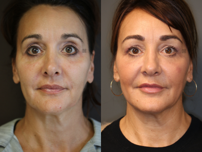 Pan Facial Rejuvenation - Upper and lower lid filler, temple and jawline rejuvenation.
