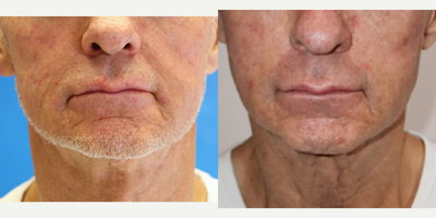 55-64 year old man treated with Silhouette InstaLift - Silhouette Instalift is an office outpatient procedure that uses absorbable threads and mini-cones to lift the mid-face cheek, smooth out the jawline and upper neck. As the threads absorb they stimulate your own collagen adding volume and contour to the face. Note: in the before view loss of volume in the cheeks and a poorly defined jaw.