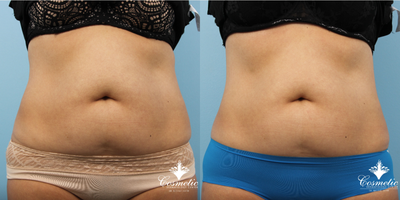 Woman treated with Emtone - Woman treated with Emtone and Emsculptfor slimmer abdomen