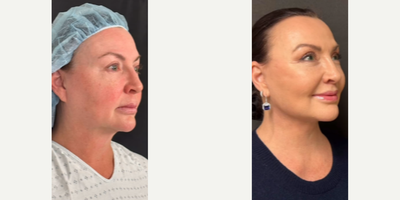 Woman treated with Buccal Fat Removal - Woman treated with Deep Plane Facelift, Neck Lift with reduction of submandibular glands, muscle, and fat with tightening of the the platysma muscle, Lip Lift, Brow Lift, and Buccal Fat Removal.