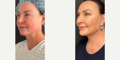 Woman treated with Buccal Fat Removal - Woman treated with Deep Plane Facelift, Neck Lift with reduction of submandibular glands, muscle, and fat with tightening of the the platysma muscle, Lip Lift, Brow Lift, and Buccal Fat Removal.