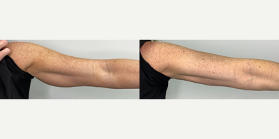 45-54 year old woman treated with i-Lipo - Lipo shots on arm