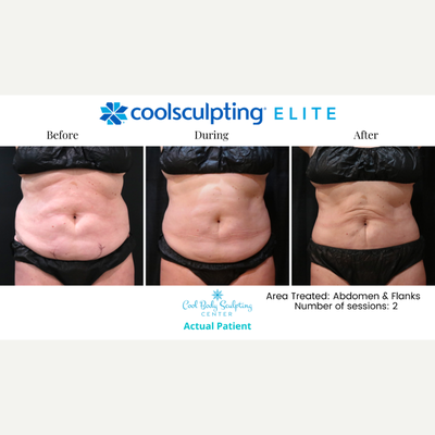 35-44 year old woman treated with CoolSculpting Elite - CoolSculpting Elite on abdomen and flanks!