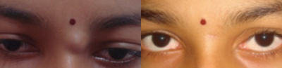 18-24 year old woman treated with Cyst Removal - Cosmetically Sebaceous Cyst Removal