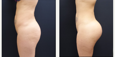 25-34 year old woman treated with Brazilian Butt Lift Revision 712cc Round Silicone Implants - The patient had a Brazilian Butt Lift several years previously which improved her shape but did not give her the projection and volume of her buttock that she desired. Her thin nature likely limited the amount of fat was available for her fat transfer procedure. To revise the Brazilian Butt Lift she had 712cc round silicone butt implants placed on each side. The implants provide the projection and shape she desires for her buttock.