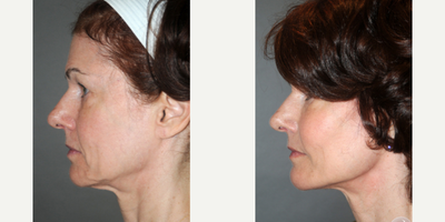 55-64 year old woman treated with Dermal Fillers - Age: 60Procedures: Y LIFT