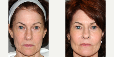 55-64 year old woman treated with Dermal Fillers - Age: 60Procedures: Y LIFT