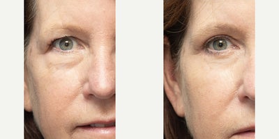55-64 year old woman treated with Eyelid Surgery - 55-64 year old woman treated with Eyelid Surgery