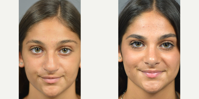 Woman treated with Septoplasty - Procedure: Rhinoplasty, SeptoplastyBefore: the surgical plan was as follows: .- Increase tip projection .- Increase tip rotation.- Shorten the nose .- Narrow the tip .- Create supra tip break After: Post op Assessment addressed:.- Nasal hump.- Desires cosmetic change.- Bulbous tip.- Hanging columella 6 months later the scars are healed, good nasal contours, and septum midline.
