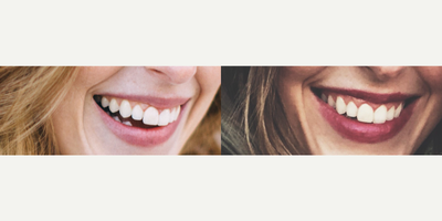 25-34 year old woman treated with Botox, Botox for Gummy Smile - Botox before and after to treat a gummy smile, by UFP Nurse Injector
