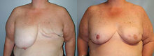 Female patient who underwent breast reconstruction  - 
	This woman underwent a left mastectomy for breast cancer in the past. She had a delayed left breast reconstruction using an expander/implant combination and a right breast reduction to improve her symmetry.
