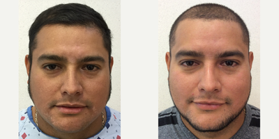 25-34 year old man treated with IPL - A 34-year-old Male treated with the Excimer Laser to improve the appearance of vitiligo and reduce discoloration.