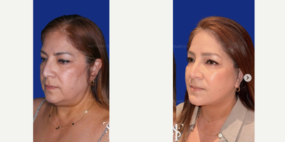 45-54 year old woman treated with Lower Facelift, Facelift, Neck Lift - 45-54 year old woman treated with Lower Facelift, Facelift, Neck Lift