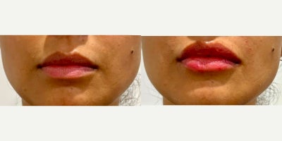 25-34 year old woman treated with Juvederm - Lips after injecting 1 syringe of Juverderm