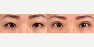 25-34 year old woman treated with Double Eyelid Surgery - Upper Blepharoplasty before and after, frontal