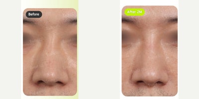 25-34 year old man treated with Alarplasty, Rhinoplasty, Asian Rhinoplasty - Wide nose reduction also known as lateral osteotomy will make your nose look slim when seen from the front!WHY 1mm?