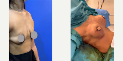 Woman treated with Breast Augmentation, Breast Lift, Motiva Breast Implants - Breast Augmentation (590 RSC Motiva Subfascial) + Doughnut Uplift - Stealth Excisions