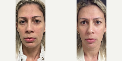 35-44 year old woman treated with Venus Legacy - Treated with Venus Legacy.