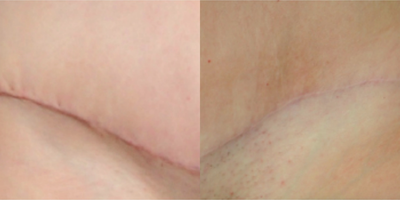 Tummy tuck scar before and after treatment with embrace - Photo provided courtesy of Neodyne Biosciences, Inc.