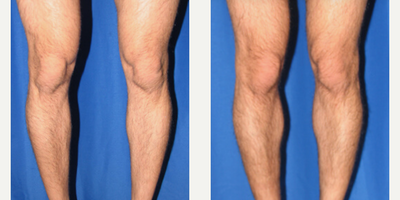 Man treated with Calf Implant - Man treated with Calf Implant