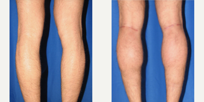 Man treated with Calf Implant - Man treated with Calf Implant