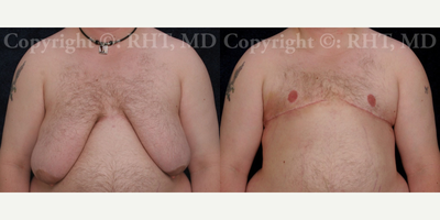 24 yo F-M transgender patient had total mastectomies and NAC grafts for Chest Masculinization - This 24 year old F-M transgender patient came to Dr. Tholen for skin-reducing total mastectomies, star-pattern nipple reduction, areola reduction and reconstruction of the nipple areola complexes (NAC) as full-thickness skin grafts for chest masculinization. He underwent a 4-hour general anesthetic outpatient operation and did extremely well. Post-op photos are at 5 months; scars will continue to fade and mature for up to a year.