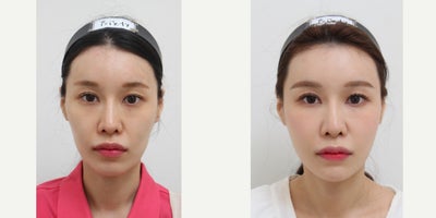 18-24 year old woman treated with Nonsurgical Facelift - Chief Complain: flat apple cheeks, hollowed side cheeks & temples, nasolabial folds, uneven under eye areaTreatment Plan: facial fat graft & under eye nano fat graftOutcome: - smooth face line - younger look through volume restore - prp injection was mixed with harvested fat for increasing survival rate of injected fat