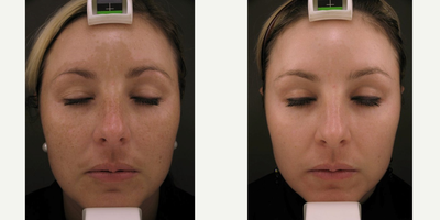 Obagi NuDerm and Botox - Transforming her skin in 16 weeks with Obagi NuDerm Starter Kit and 25 units of Botox.