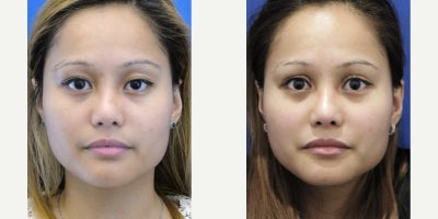 25-34 year old woman treated with Double Eyelid Surgery - She desires more definition on the inner corners of the eyelid crease. Procedure done under local anesthesia achieves eyelid crease deepening by utilizing ptosis repair technique and judicious fat pad removal.