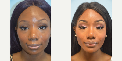 African American Rhinoplasty and Chin Implant - Patient presented with concern about the width of the bridge of her nose. After seeing computer imaging a chin implant was suggested in addition to the Rhinoplasty.
