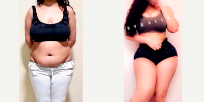 25-34 year old woman treated with Tummy Tuck, Liposuction, Brazilian Butt Lift - Excellent outcome after full body intense liposuction including abdomen, waist, laterals, upper and lower back plus DOMINICAN BUTT LIFT by Mallol getting better volume, contour and butt projection.