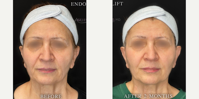 65-74 year old woman treated with Skin Tightening - Endolift skin tightening for the Midface and Neck