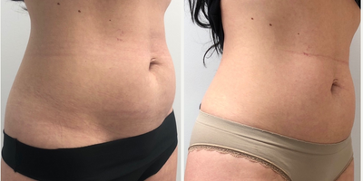 35-44 year old woman treated with UltraShape Power - 3 sessions Ultrashape for abdomen recontouring. Treats 32% of fat in the area treated.
