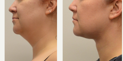 35-44 year old woman treated with Chin Liposuction - Chin and neck liposuction