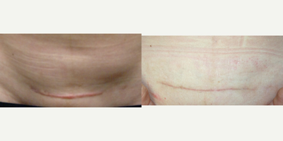 25-34 year old woman treated with Scar Removal - C-Section Scar revision