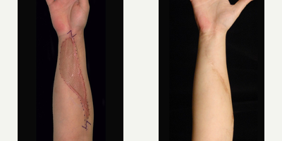Arm Scar Revision - This is a 20-year-old woman who had a traumatic injury to her right forearm. During her reconstruction, skin grafts were applied, and she developed thick scars around the edges.Dr. Sterry was able to surgically remove all of the skin graft and the thickened scars. Unharmed, normal skin was then closed over the wound during her scar revision treatment. Medicinal ointments were applied for the next several weeks.