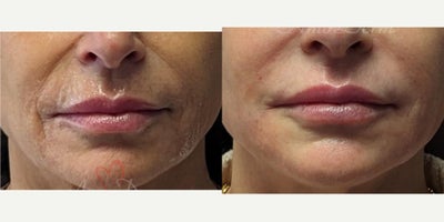 55-64 year old woman treated with Juvederm, Vollure, Restylane - Treatment of nasolabial folds, marionette lines & lines around mouth with Juvederm, Voluma, Vobella, Vollure, Restylane