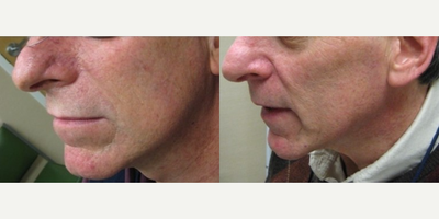 Man treated with Excel V - Man treated with Excel V