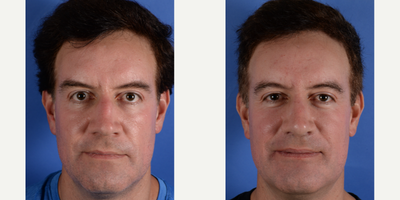 45-54 year old man treated with Alarplasty - This is a healthy male who presented with a history of two prior rhinoplasties. He was bothered by the significant hump noted on his profile in addition to the width of his nostrils. After evaluation and discussion in clinic, it was determined that the hump appeared after placement of Gore-Tex under the bridge for camouflage during the revision procedure. The skin started to appear discolored and tender. He underwent an open rhinoplasty procedure with us to remove the foreign material, smooth the bridge and cover it with fascia from his temple, and narrow the width of the nostrils. Gore-Tex, medical-grade material is often used to hide irregularities underneath the skin of the nose, but it can produce poor results. As a result, we use temporalis fascia which is a natural blanket that comes from the patient's temple region.