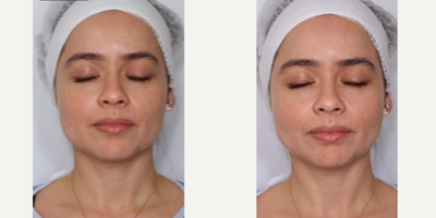 Woman treated with Botox for Migraines - MIGRAINE BOTOXDid you know that BOTOX is great for migraine patients?Apply in small doses at several strategic points around the head and neck.