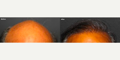 Man treated with Hair Transplant - Man treated with Hair Transplant forHair Loss Treatment
