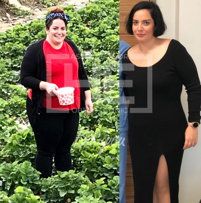 25-34 year old woman treated with Gastric Bypass - Type 2 Diabetes patient lost 30 kg in 8 months. Her weight loss process didnt end.We are proud of her.