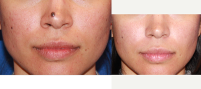 27year old female treated with Mole Removal - My patient was not happy with the mole on her nose. She sought me out for removal of the lesion. We discussed options of excising it completely vs a shave excision. We decided on a shave excision to minimize the chances of scarring. Here she is 7m after.