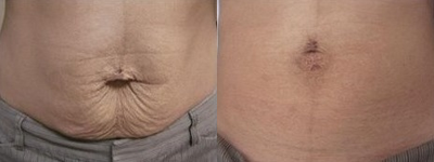 Skintyte - Woman treated with Skintyte