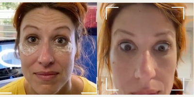 Woman treated with Botox - Woman treated with Botox