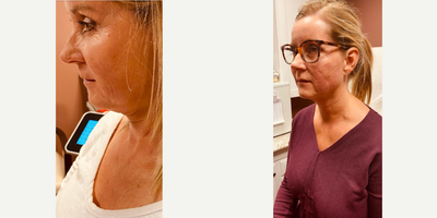 Woman treated with Nonsurgical Facelift - Evoke after 2 treatments