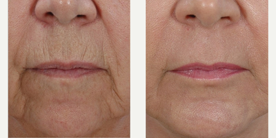 55-64 year old woman treated with Skin Tightening - This patient is shown before, and 6 years after her Resurfacing Perfected treatment!